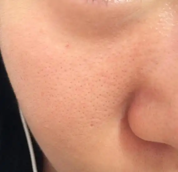 20岁 毛孔粗大 皮肤松弛