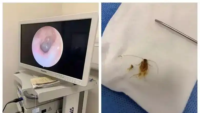 震惊!女子从马尔代夫急匆匆飞回南京,只因耳朵里有一只