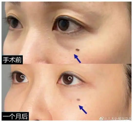 眶隔脂肪释放 77眼窝凹陷填充案例图一上图是术前正面,下图是术后