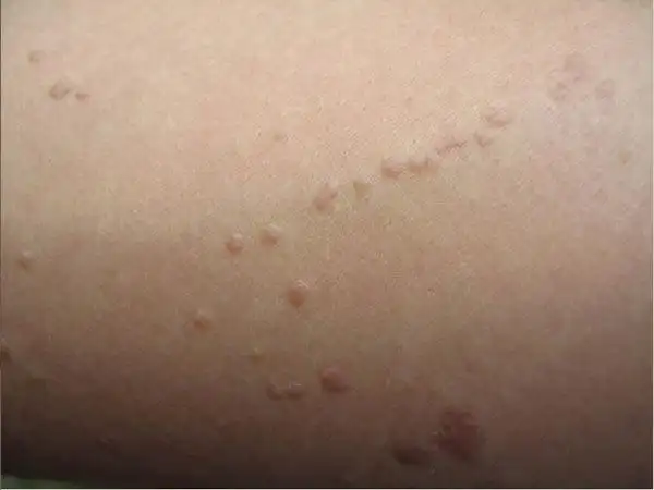 我和扁平疣的5年之恋