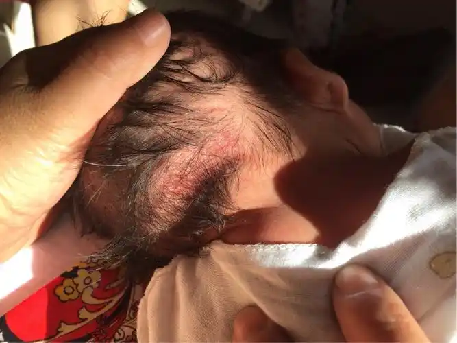 大家知道孩子后脑勺起一片红是怎么回事嘛