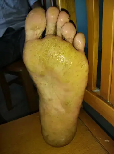 反复发作持续生长的双足底皮肤大面积角质化