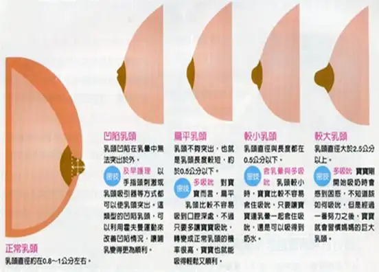 ②乳腺间纤维组织过短①先天的乳腺内平滑肌发育不良造成乳头凹陷的