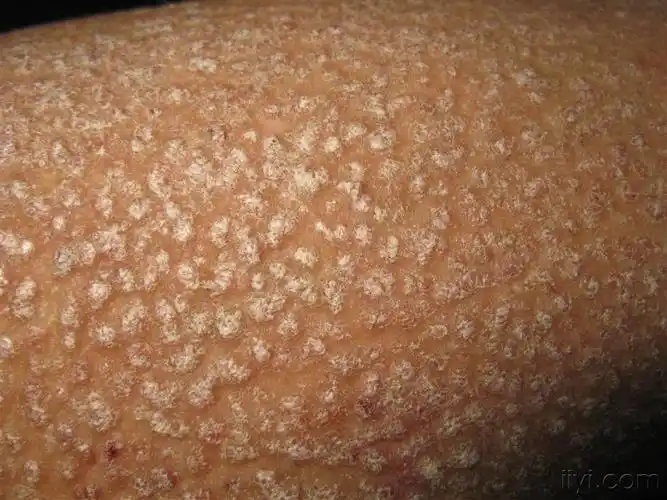 看图识病皮肤淀粉样变