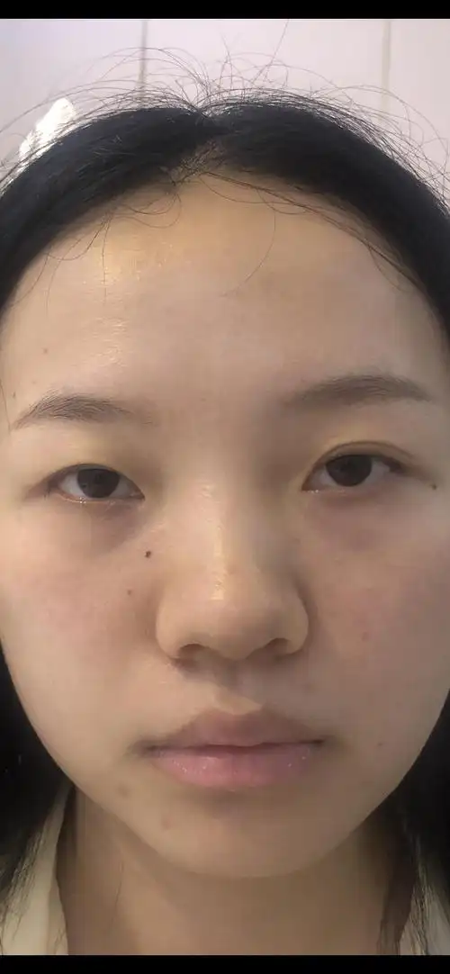 提肌无力矫正是不是不能做平扇