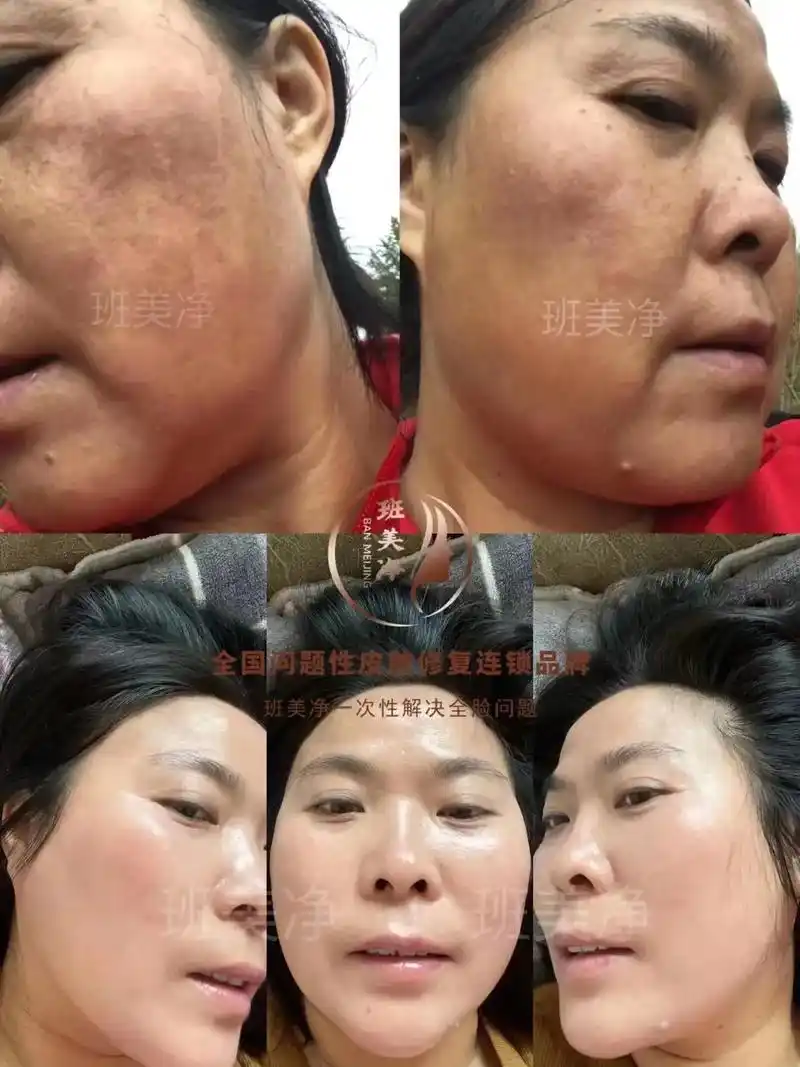 重返青春.不管你几岁,只要脸上有斑斑点点,那么你就会比你同龄 - 抖音