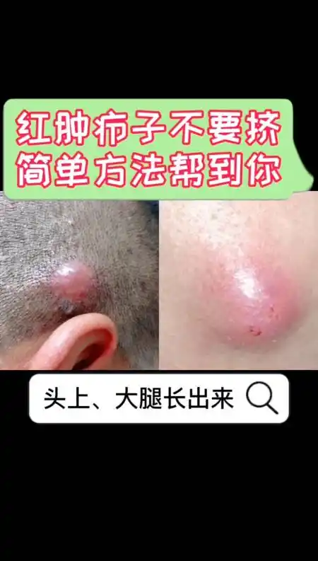 每天一点冷知识#"火疖子"又肿又痛,你知道怎么办吗0969♂15-度