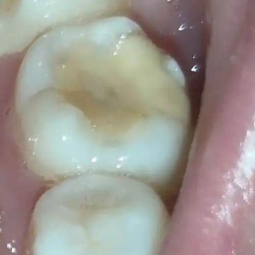 左边第二磨牙侧面2021-09-01 16:29:29已编辑来自:岳峙渊渟