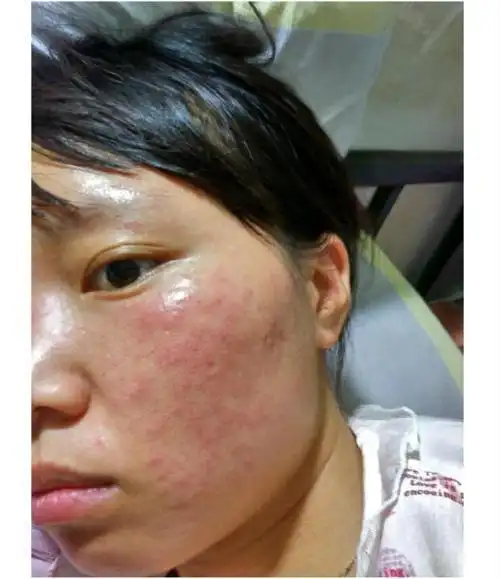 分享脸上有红血丝用什么药可以去掉-修复激素脸的文章-企博网职业博客