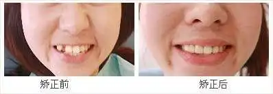在30岁矫正牙齿是怎样的一种体验?