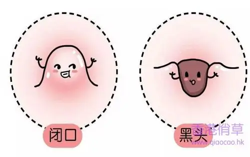 关于闭口粉刺怎么去除,闭口痘痘怎么去除? - 俏草美妆博客