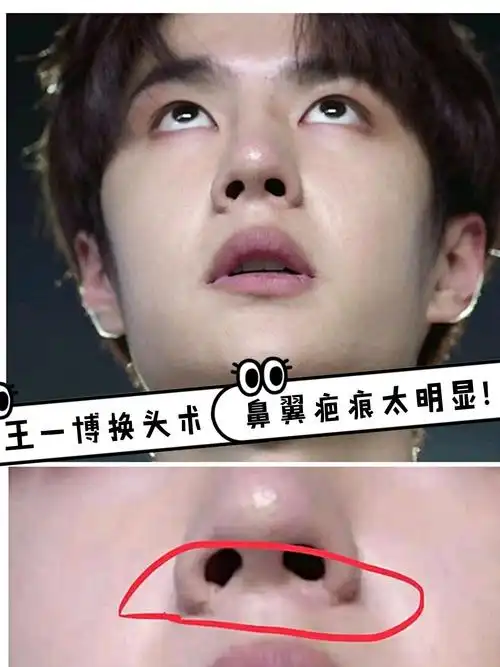 王一博换头术 鼻翼疤痕太明显?
