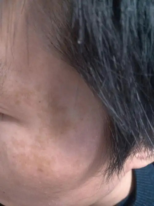 我的两个眼角附近都有黑斑,最近几年越来越大了,不知是什么原因.