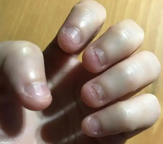 原创孩子咬指甲成瘾是缺维生素吗父母了解真正原因才能解决