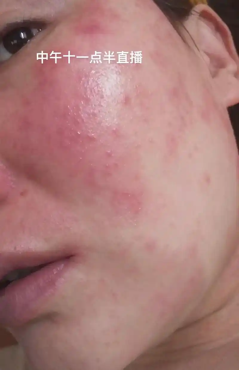 问题性皮肤管理 #玫瑰痤疮 #激素脸 #脂溢性皮炎 如果你 - 抖音