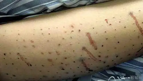 女孩为减肥腿上扎100个窟窿眼 妹子你够了!