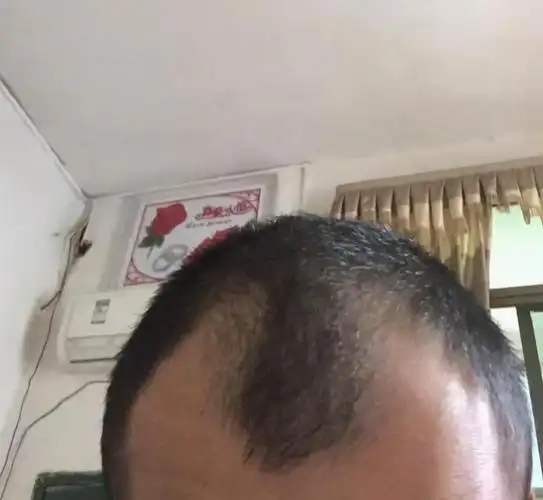 31岁男子严重m型脱发,为了长出头发戒烟戒酒,还是快要秃了_手机搜狐网