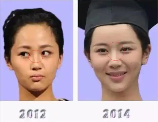 杨紫整容了吗杨紫整容史