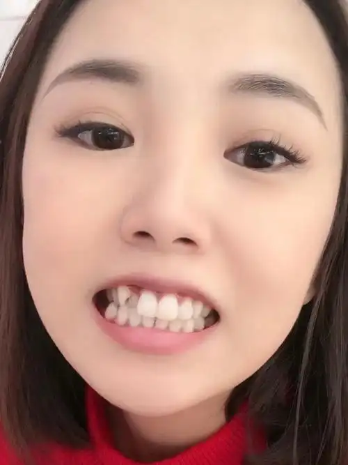 我有个牙齿长的很外面 就是虎牙 这颗牙搞得我嘴又凸_圈子-新氧美容