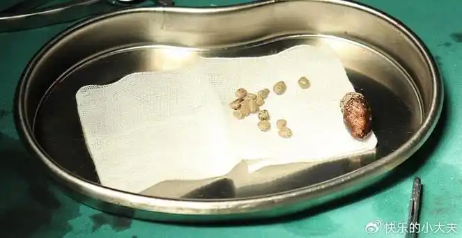 过多的钙,草酸,尿酸或胱氨酸等在尿液中过饱和析出形成结晶,是结石