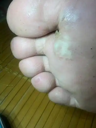 走路超过1公里脚会起泡,起初在皮肤下硬的小泡,挤压很痛,要点脚尖走