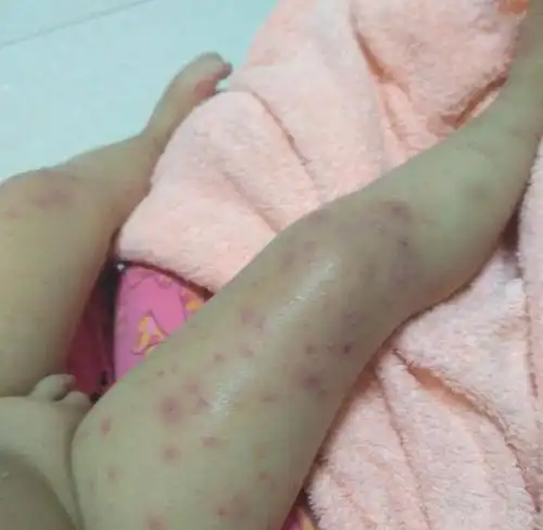 背上有零星几点 去到传染病医院,医生看了下,也觉得手足口的可能性