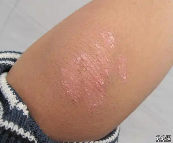 双肘部皮疹一年