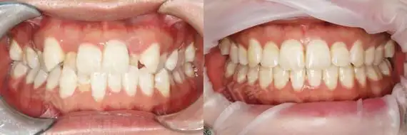 口内治疗前后对比