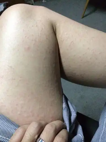 只要一运动或者感觉燥热就会起一大片小包包.很痒.