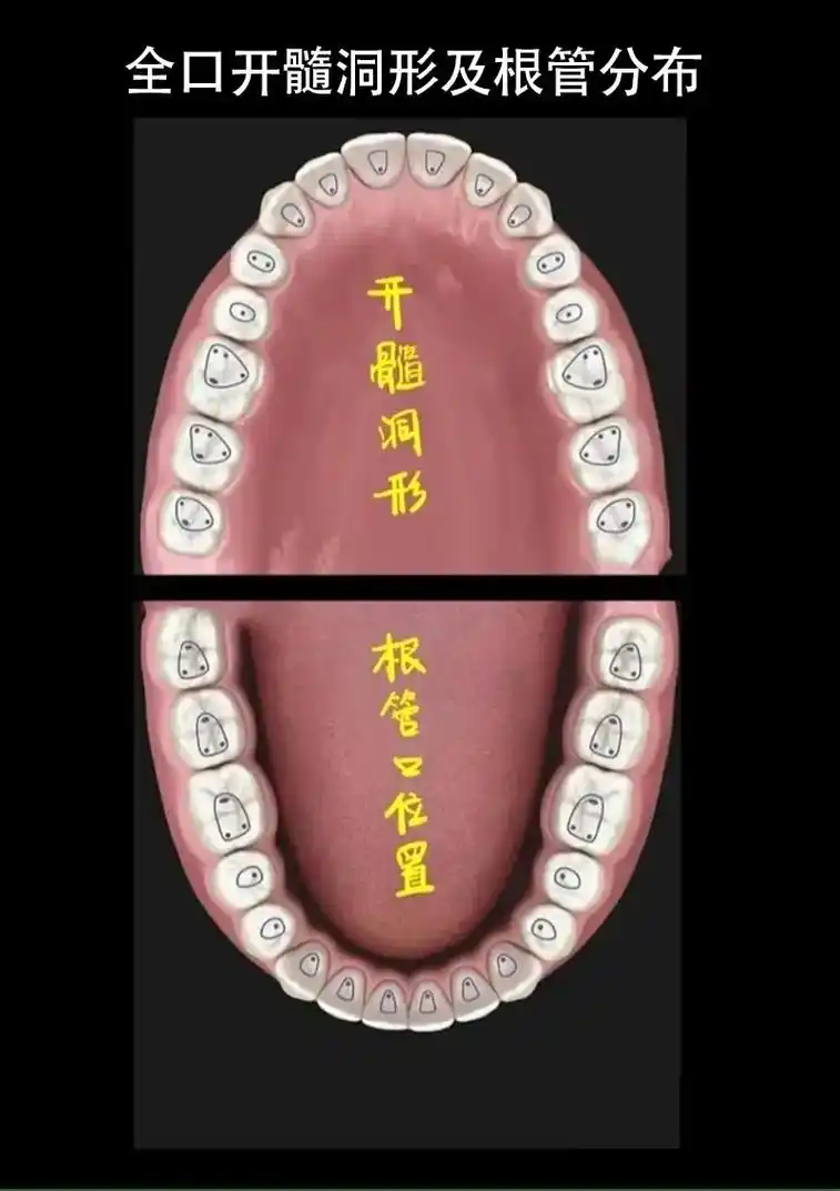 全口开髓洞形及根管分布#口腔科普 #一口好牙 #美牙修复 # - 抖音