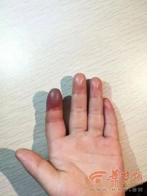 家长注意!西安4岁女童皮筋套手指睡着 手指缺血性坏死差点截肢