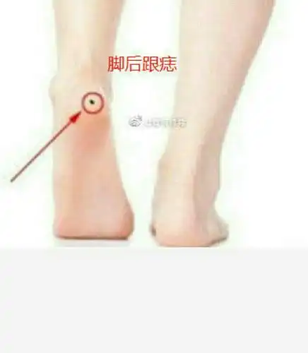 3,脚后跟痣,这属于厄运缠身痣,表示常常会麻烦不断,做事情往往事半功