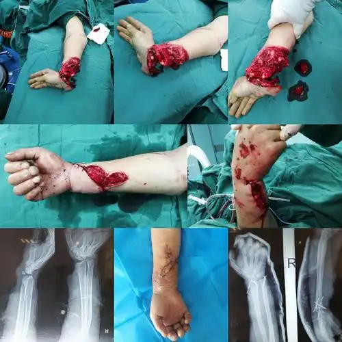 大同五院骨四科成功救治一名腕关节离断伤患者