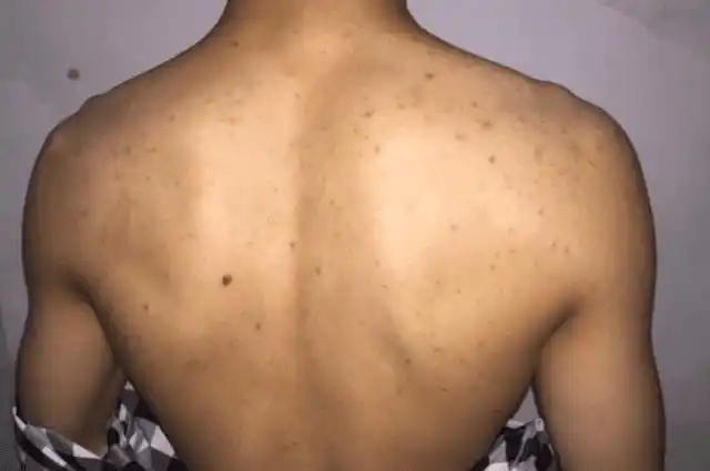 背后长的红疙瘩,是痘痘还是毛囊炎?为什么总是去不掉?