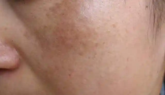 夏天到了为什么你的皮肤越来越暗黄还长斑