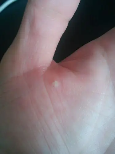 手掌上长了一个硬邦邦的东西,都两个多月了还没消