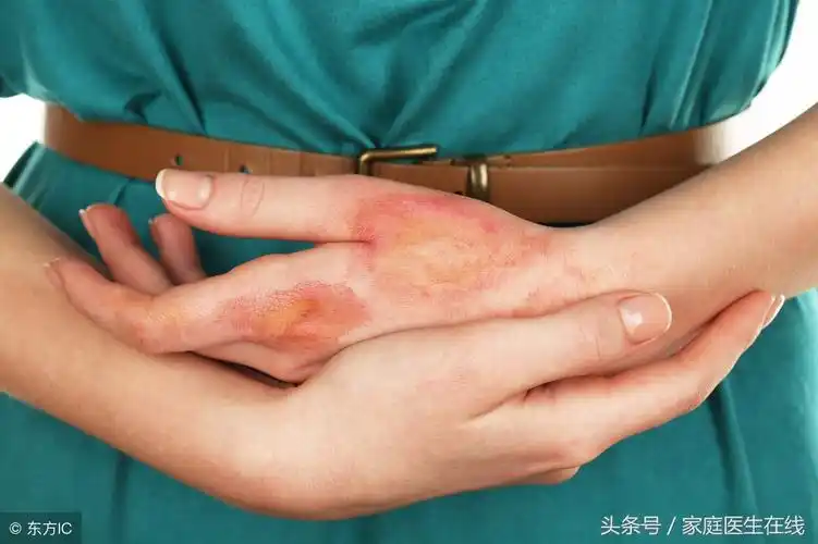 不小心被烫伤?这份处理指南请收好,让伤口恢复更快