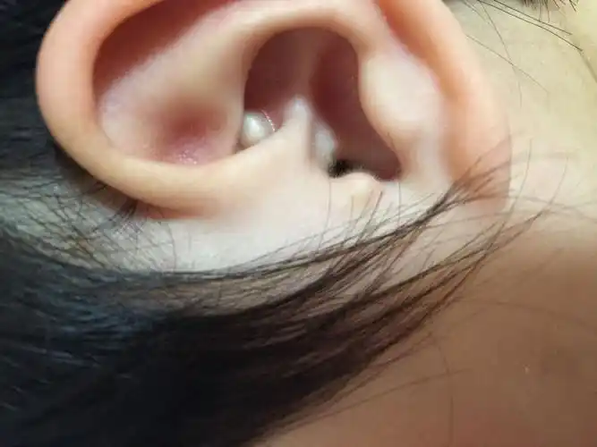 请问有人知道宝宝耳朵里长的像豆子大小的小包是怎么回事吗?