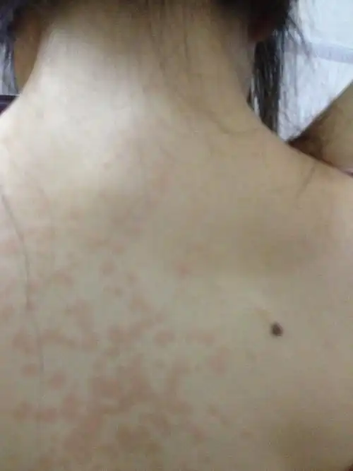 背上长了好多红印子而且有点凸起也不痒但是好难看啊要怎么才能消除啊