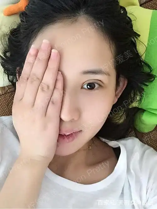 学妹做全切双眼皮 开眼角1个月后问:平行扇形双眼皮是这样的吗?