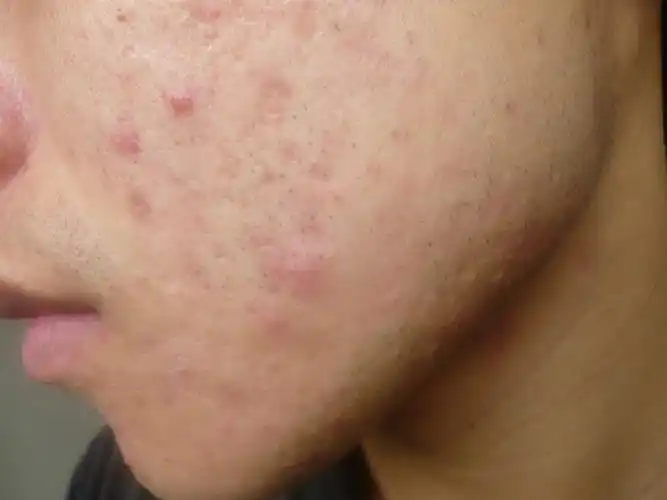 什么轻度痤疮图症状片