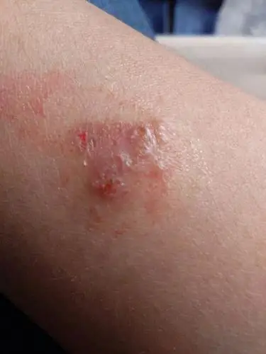 热心网友 你好手指胳膊脚脖子上长小泡这样考虑是存在毛囊炎疾病导致