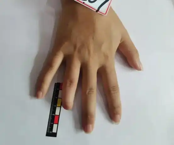 辅助器具费-假手指