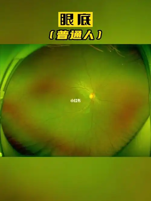 普通人和高度近视的眼底对比