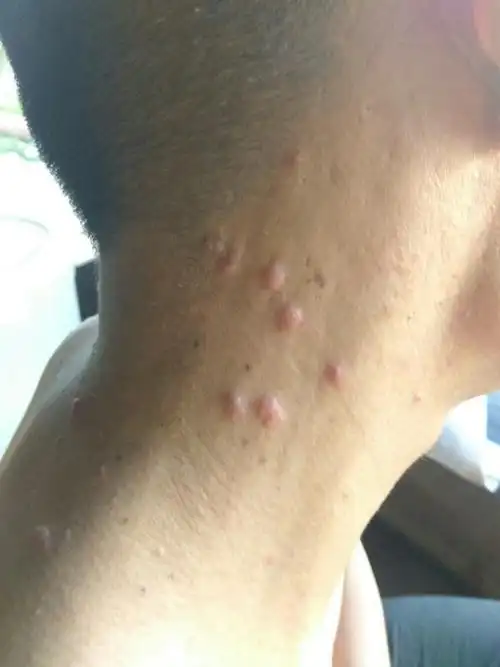 您好,就你那的描述来看,您所说的症状情况,应该是颈部的毛囊炎,也可能