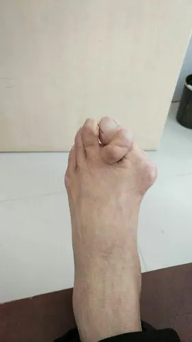 踇外翻 大脚骨
