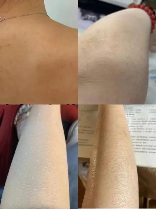 秋冬身上干燥起皮屑干痒怎么办三甲皮肤科医生教你秋冬身体补水保湿