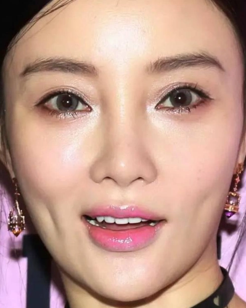 李小璐的双眼皮变窄了 田永成解析双眼皮修复难点