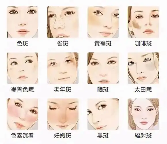 你是什么类型的斑长斑的根本原因是什么