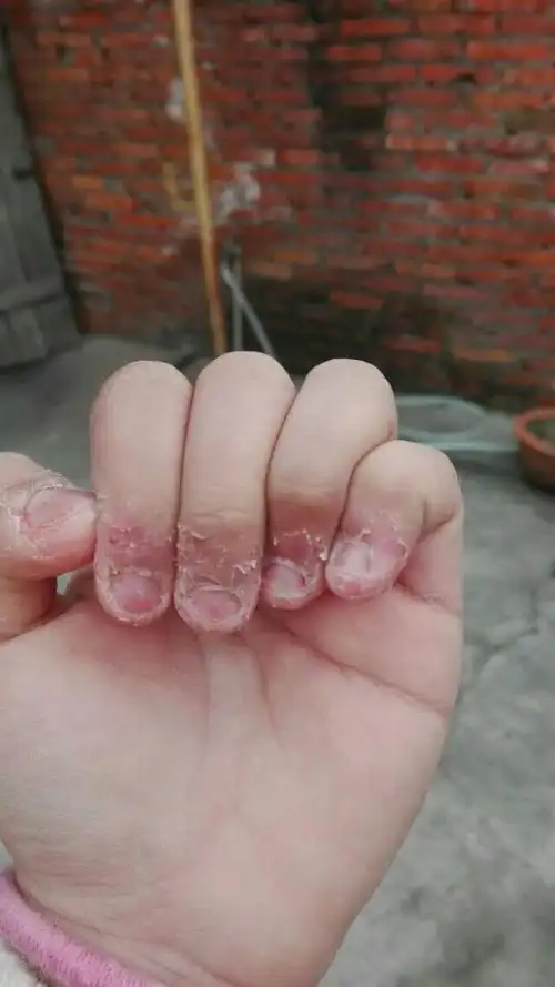 喜欢咬指甲,咬成这样,该怎么帮,本人13岁了,以后会好吗